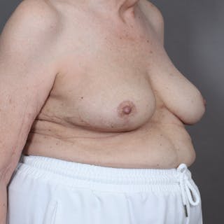 Oncoplastic Breast Reconstruction Before & After Gallery - Patient 888114 - Image 4