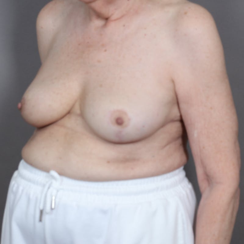 Oncoplastic Breast Reconstruction Before & After Gallery - Patient 888114 - Image 6
