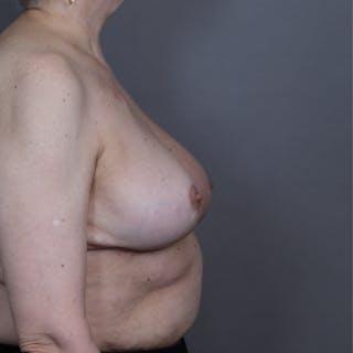 Oncoplastic Breast Reconstruction Before & After Gallery - Patient 293465 - Image 6