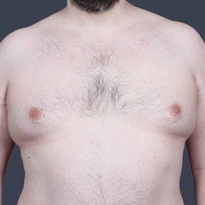 Male Reduction/Gynecomastia Before & After Gallery - Patient 275152 - Image 1