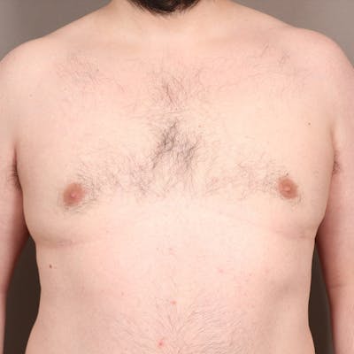 Male Reduction/Gynecomastia Before & After Gallery - Patient 275152 - Image 2