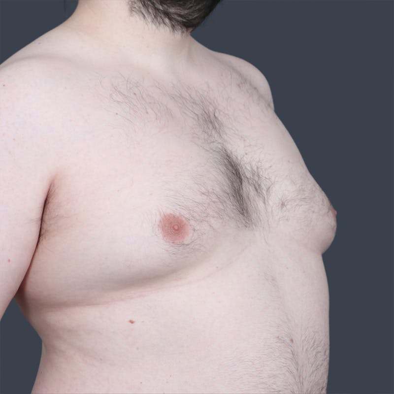 Male Reduction/Gynecomastia Before & After Gallery - Patient 275152 - Image 3