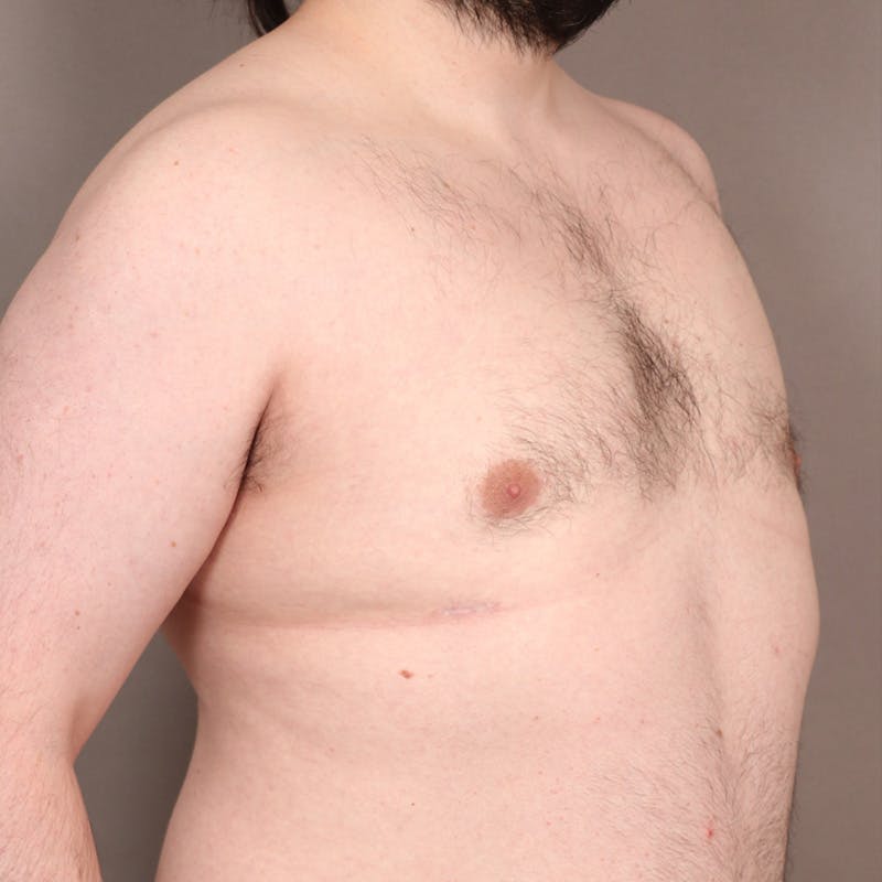 Male Reduction/Gynecomastia Before & After Gallery - Patient 275152 - Image 4