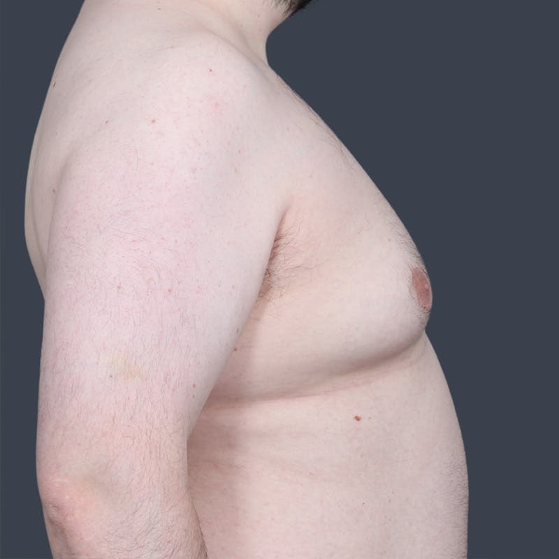 Male Reduction/Gynecomastia Before & After Gallery - Patient 275152 - Image 5