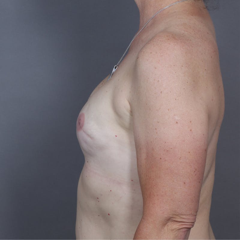 Breast Reconstruction Revision Before & After Gallery - Patient 541445 - Image 5