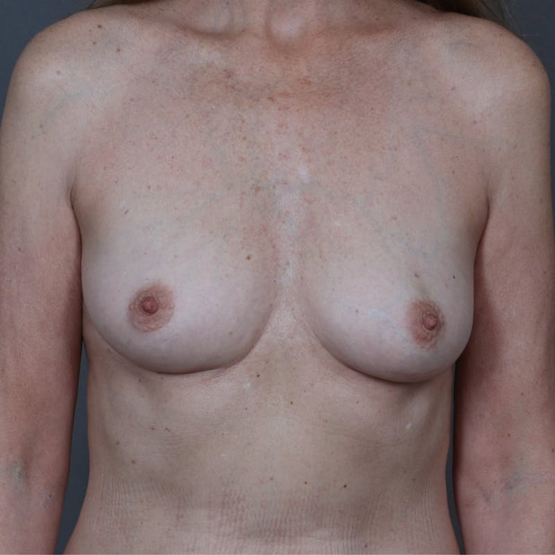 Implant Breast Reconstruction Before & After Gallery - Patient 343791 - Image 1