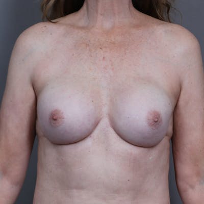 Implant Breast Reconstruction Before & After Gallery - Patient 343791 - Image 2