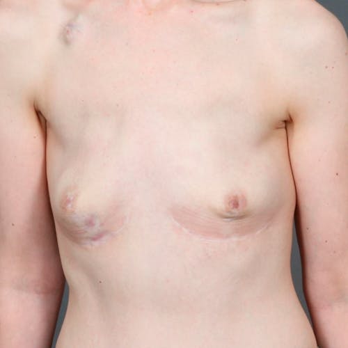 Before procedure image for Hybrid Breast Reconstruction
