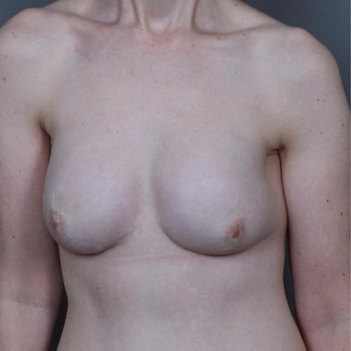 After procedure image for Hybrid Breast Reconstruction