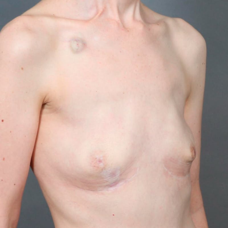 Hybrid Breast Reconstruction Before & After Gallery - Patient 358966 - Image 3