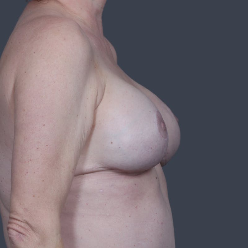 Hybrid Breast Reconstruction Before & After Gallery - Patient 118726 - Image 6