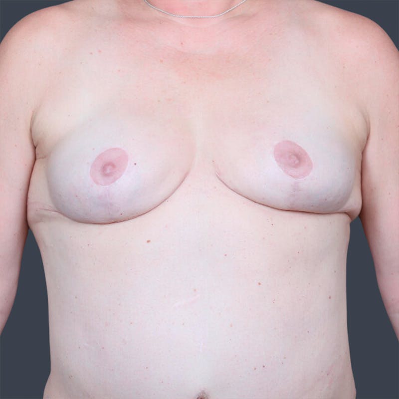 Hybrid Breast Reconstruction Before & After Gallery - Patient 118726 - Image 1