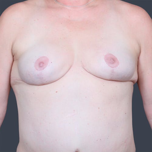 Before procedure image for Hybrid Breast Reconstruction
