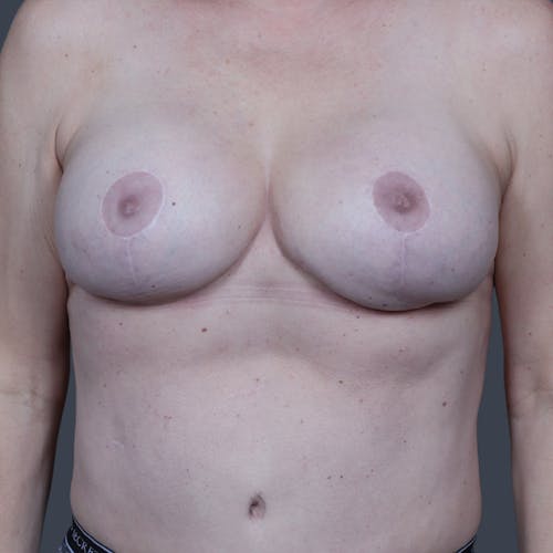 After procedure image for Hybrid Breast Reconstruction