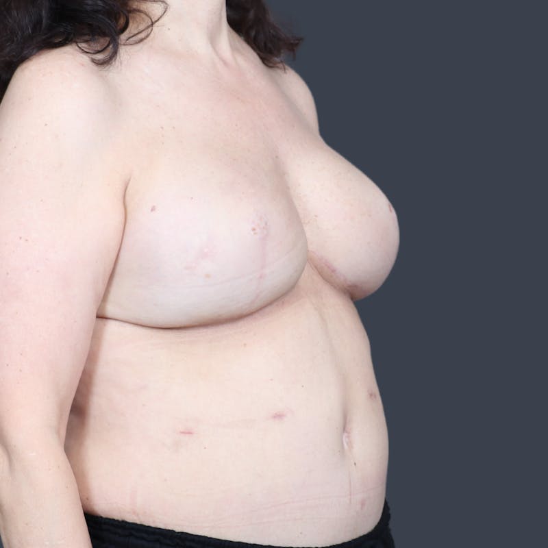 Hybrid Breast Reconstruction Before & After Gallery - Patient 255539 - Image 4