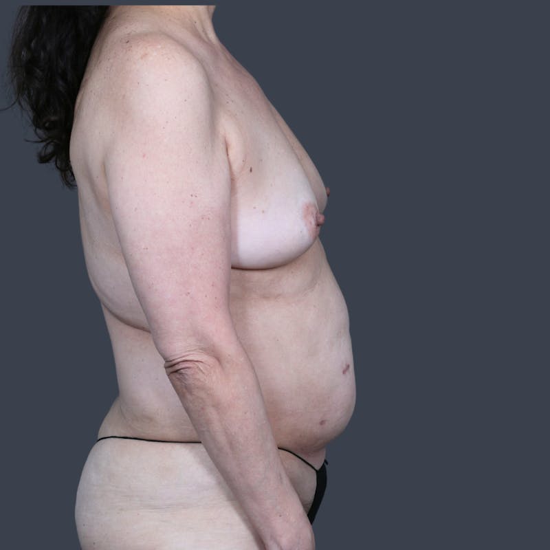 Hybrid Breast Reconstruction Before & After Gallery - Patient 255539 - Image 5