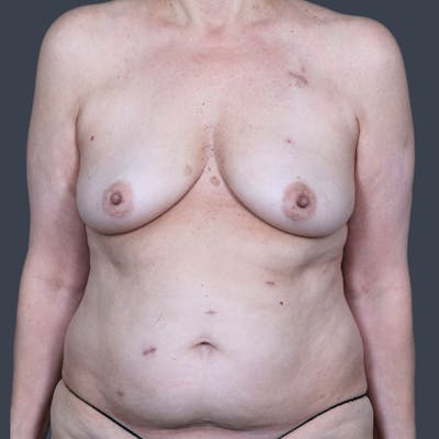 Hybrid Breast Reconstruction Before & After Gallery - Patient 255539 - Image 1