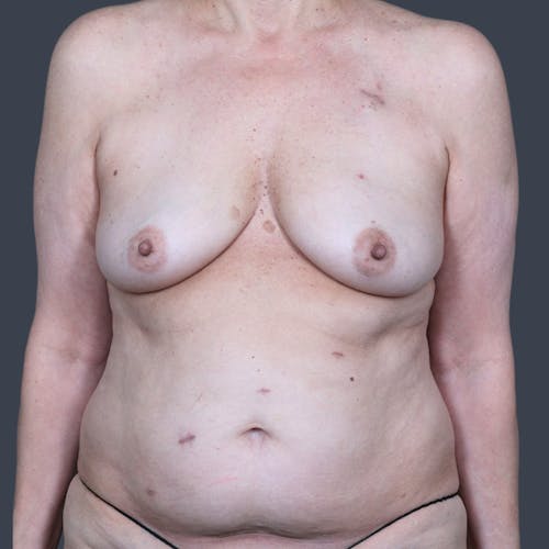 Before procedure image for Hybrid Breast Reconstruction