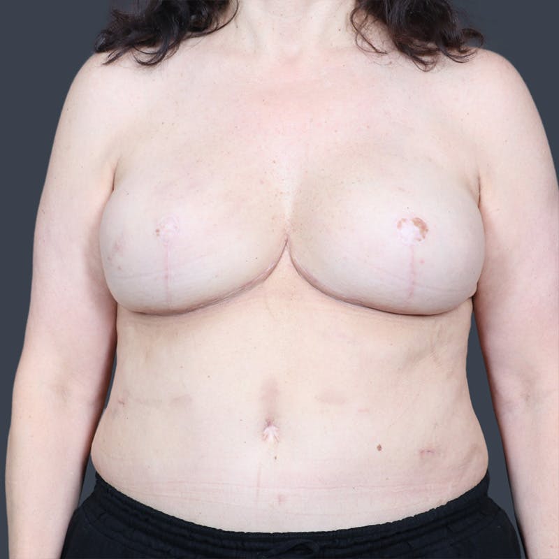 Hybrid Breast Reconstruction Before & After Gallery - Patient 255539 - Image 2