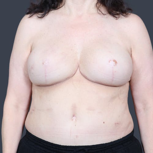 After procedure image for Hybrid Breast Reconstruction