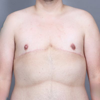 Top Surgery Before & After Gallery - Patient 241742 - Image 2