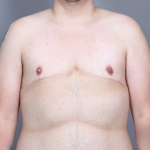 After procedure image for Top Surgery