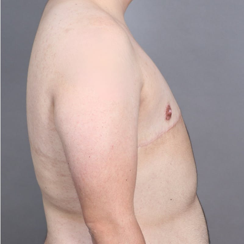 Top Surgery Before & After Gallery - Patient 241742 - Image 6