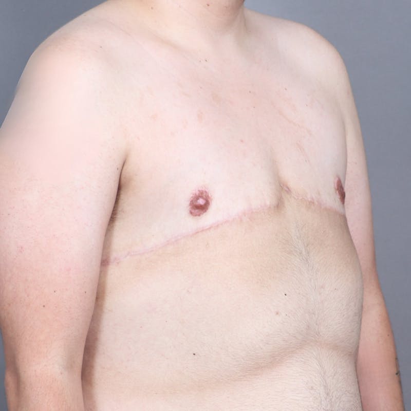 Top Surgery Before & After Gallery - Patient 241742 - Image 4