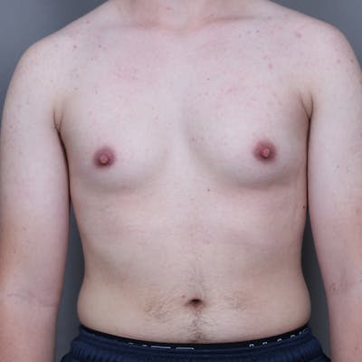 Top Surgery Before & After Gallery - Patient 423645 - Image 1