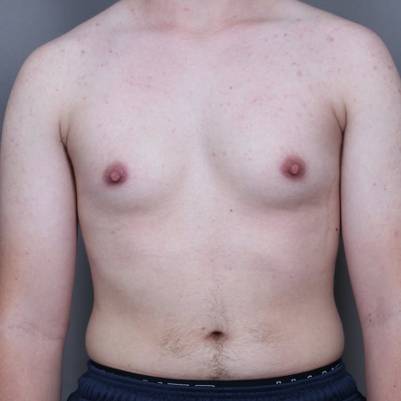 Top Surgery Before & After Gallery - Patient 423645 - Image 1