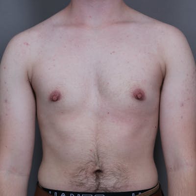 Top Surgery Before & After Gallery - Patient 423645 - Image 2