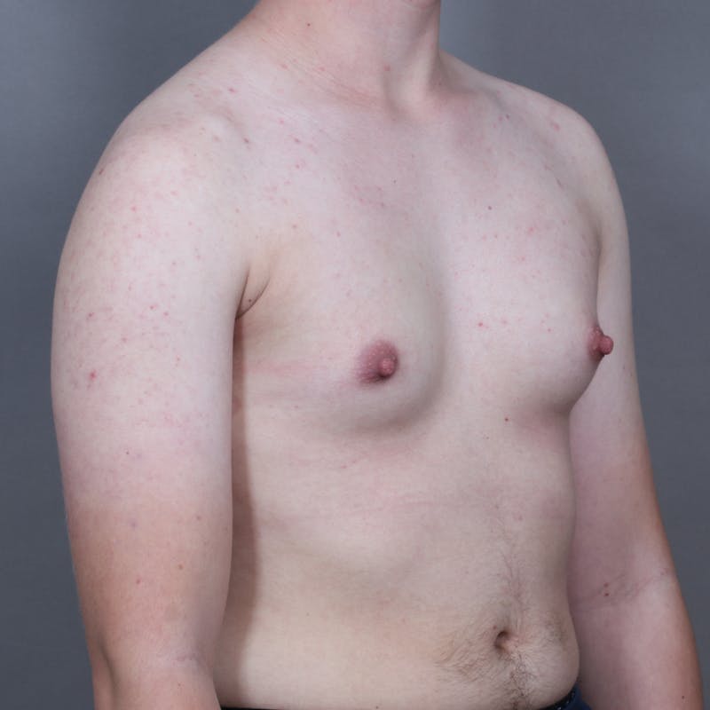 Top Surgery Before & After Gallery - Patient 423645 - Image 3