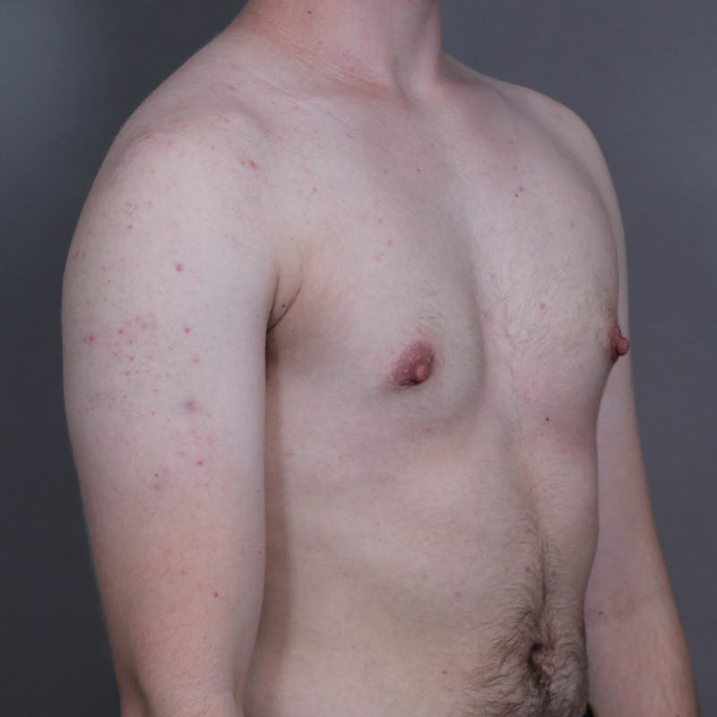 Top Surgery Before & After Gallery - Patient 423645 - Image 4