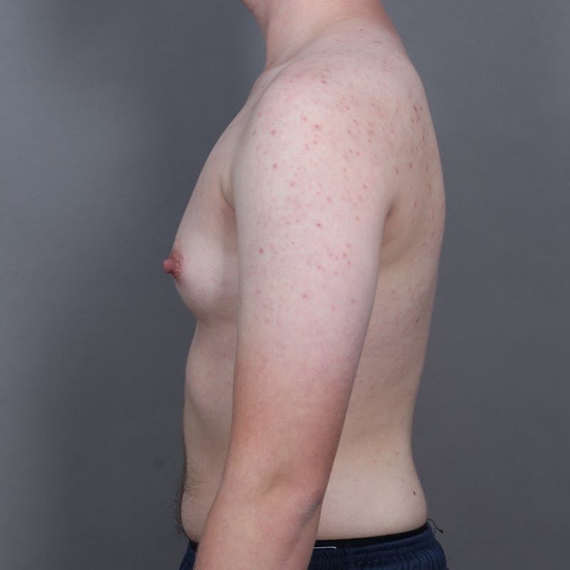 Top Surgery Before & After Gallery - Patient 423645 - Image 5