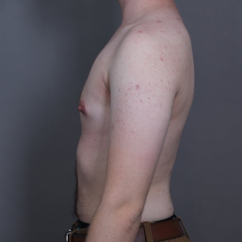 Top Surgery Before & After Gallery - Patient 423645 - Image 6