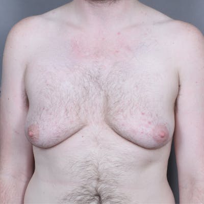 Top Surgery Before & After Gallery - Patient 158019 - Image 1