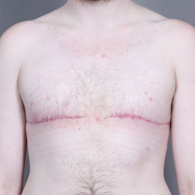 Top Surgery Before & After Gallery - Patient 158019 - Image 2