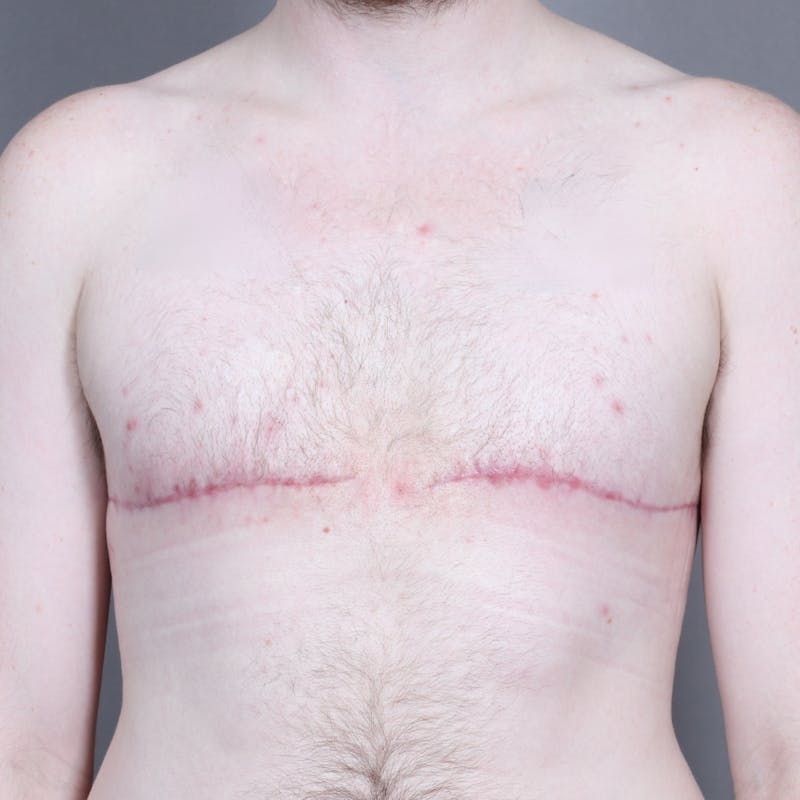 Top Surgery Before & After Gallery - Patient 158019 - Image 2