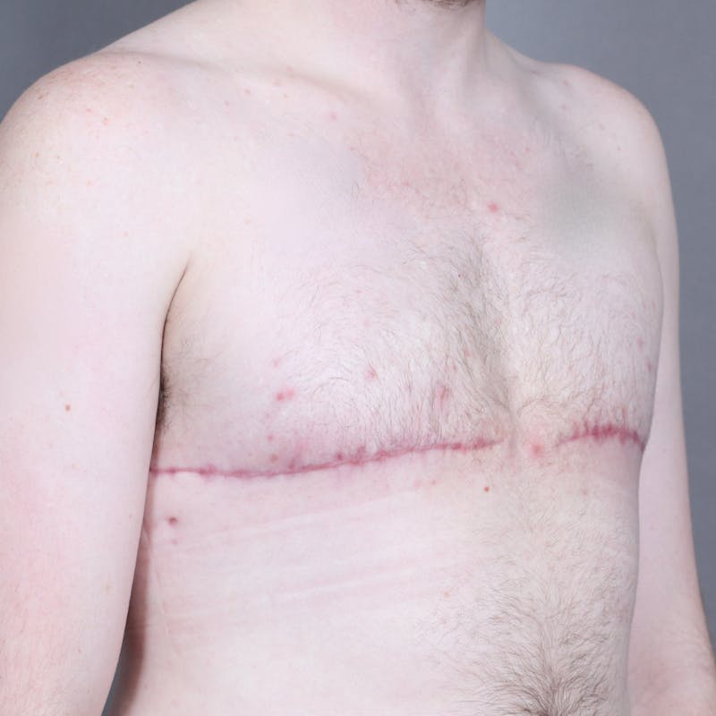Top Surgery Before & After Gallery - Patient 158019 - Image 4