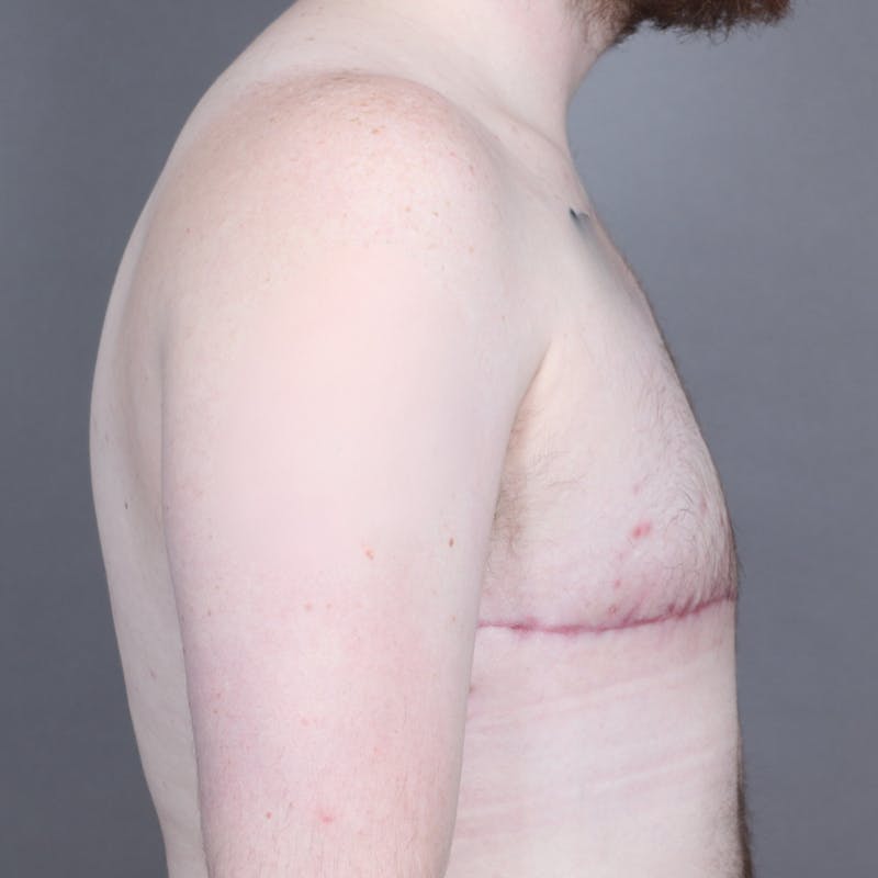 Top Surgery Before & After Gallery - Patient 158019 - Image 6