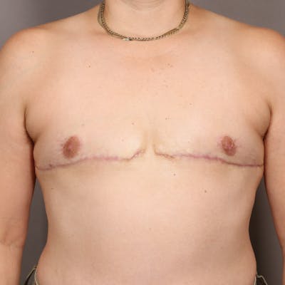 Top Surgery Before & After Gallery - Patient 124653 - Image 2