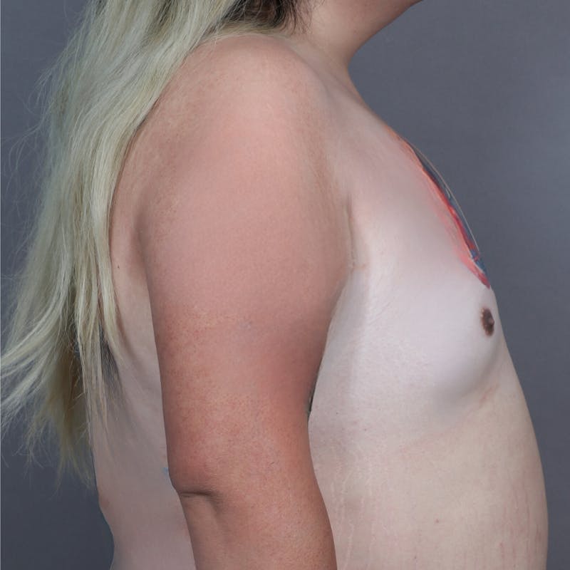 Top Surgery Before & After Gallery - Patient 373302 - Image 3