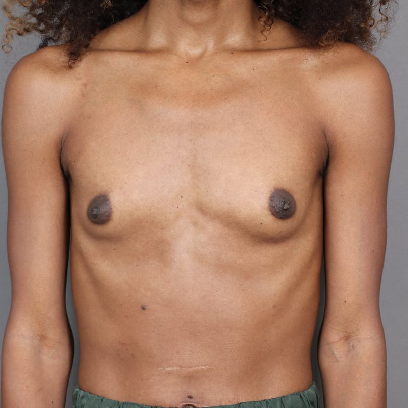 Top Surgery Before & After Gallery - Patient 225077 - Image 1