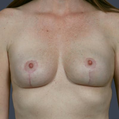 Breast Reduction Before & After Gallery - Patient 401840 - Image 2