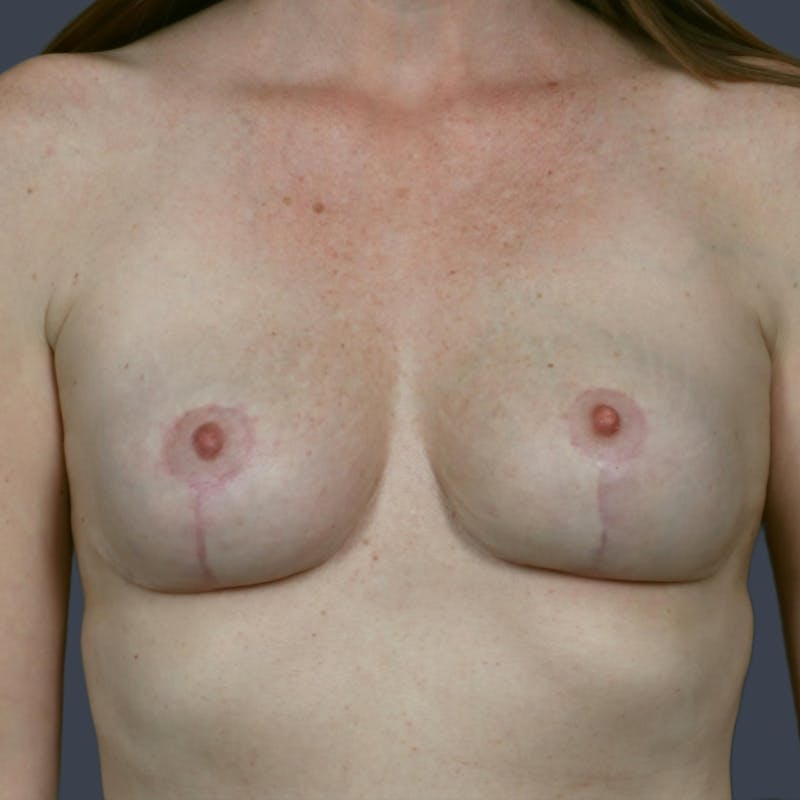 Breast Reduction Before & After Gallery - Patient 401840 - Image 2