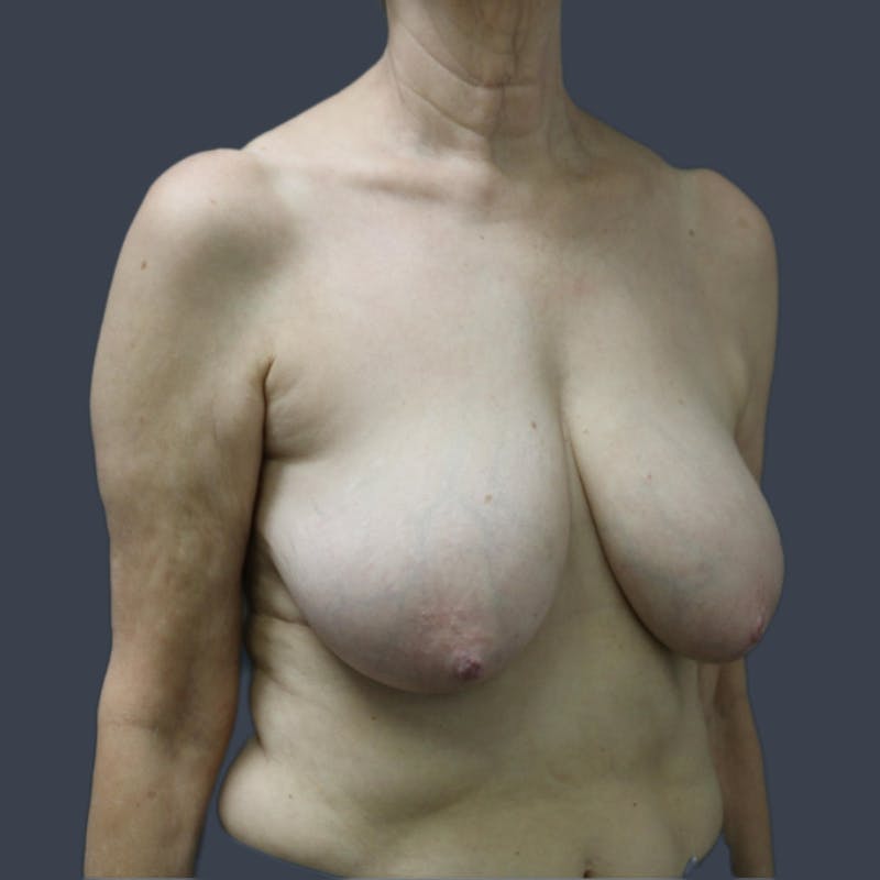 Breast Reduction Before & After Gallery - Patient 253180 - Image 5