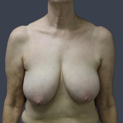 Breast Reduction Before & After Gallery - Patient 253180 - Image 1