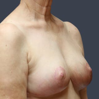 Breast Reduction Before & After Gallery - Patient 253180 - Image 6