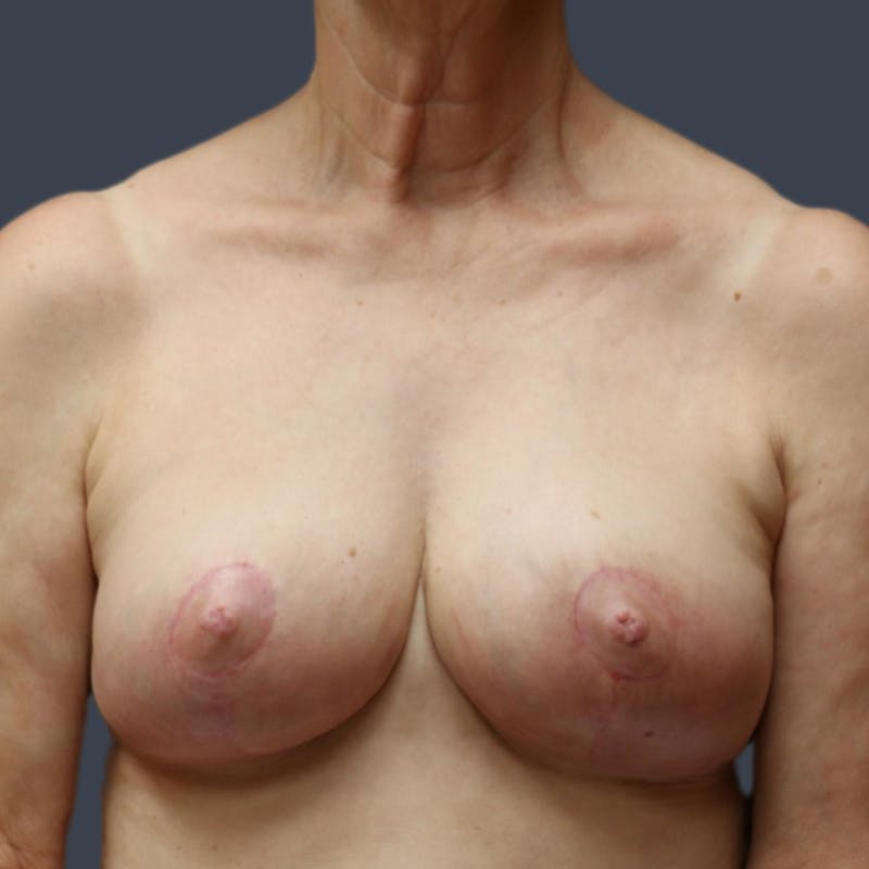 Breast Reduction Before & After Gallery - Patient 253180 - Image 2