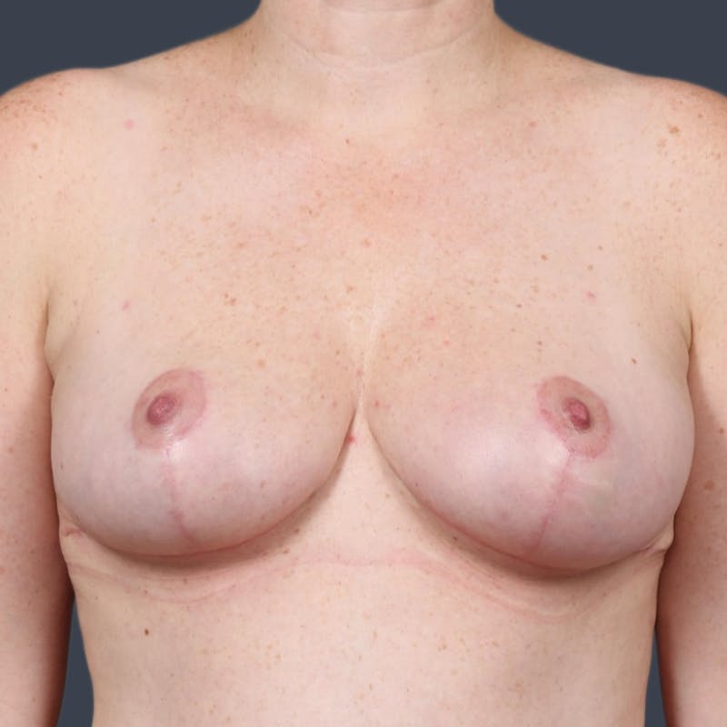 Breast Reduction Before & After Gallery - Patient 334925 - Image 2
